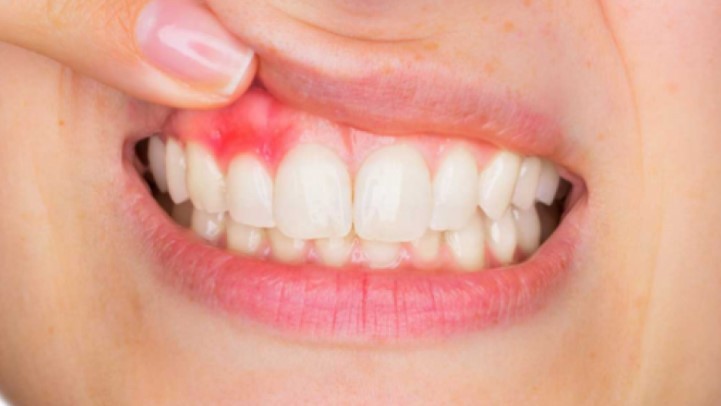 dis-eti-hastalikleri Diş Eti Hastalıkları