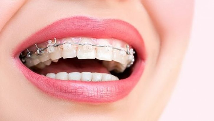 dis-teli Diş teli tedavisi ortodonti